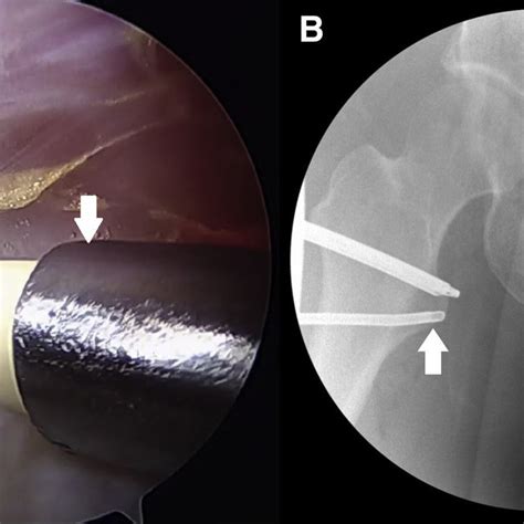Right Hip Endoscopic Image Showing The Lesser Trochanter Arrow That
