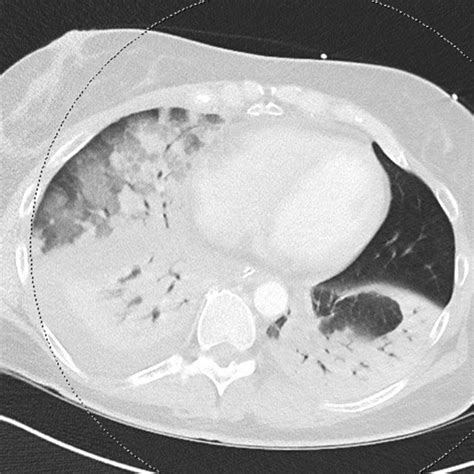 Thoracic Ct Scan Showing Bilateral Pneumonic Infiltrations And