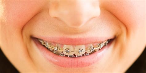How To Manage Pain And Discomfort From Broken Braces Dentist Olds