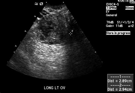 Sonographic Evaluation Of A Ruptured Ectopic Pregnancy Laura A Payken
