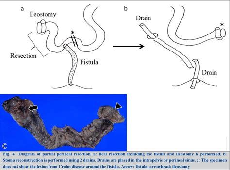 Figure From Crohn Disease In Patients With Fistula From A Perineal Wound To The Ileum