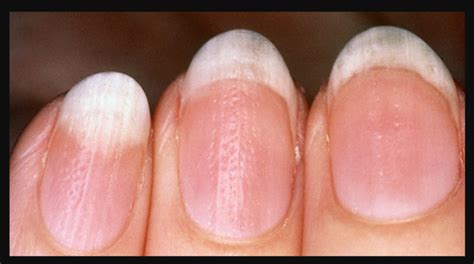 3 Nail Disorders You Must Never Ignore