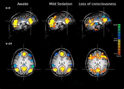 Frontiers Brain Connectivity In Pathological And Pharmacological Coma