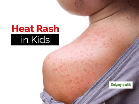 Heat Rash In Kids Try These Effective Natural Treatments For Relief