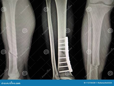 Fracture Of Leg With Post Op Fixation Royalty Free Stock Photography