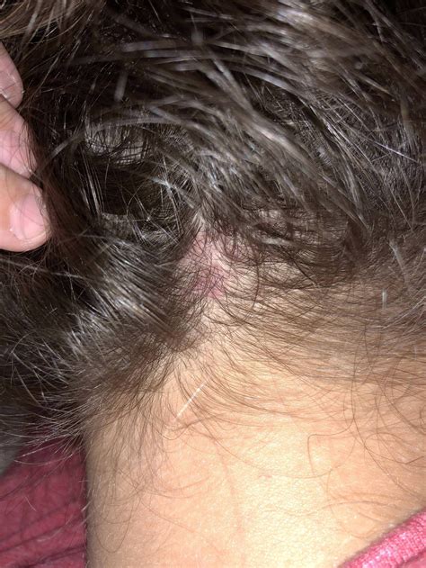 What Is This Red Circular Rash Looking Thing On The Back Of My Head