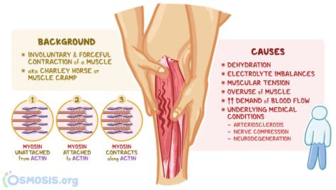 Muscle Spasms What Are They Causes Diagnosis And More Osmosis