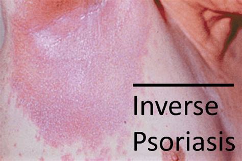 Warnings 6 Types Of Psoriasis And 4 Skin Conditions You Need To Know