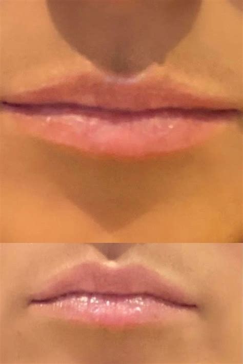 Lip Flip Before And After Medical Esthetician Botox Injections Lips