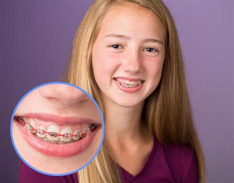Colorful Teeth Braces Ideas Be Irresistible And Make A Fashion Statement