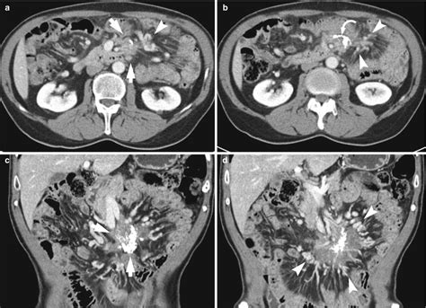Benign Diseases Of The Mesentery And Omentum Radiology Key