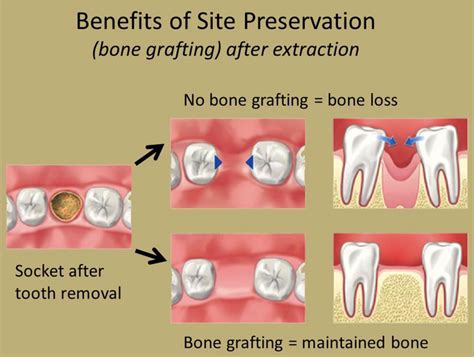 Socket Preservation Aiken Dentist North Augusta Dentist Edgefield