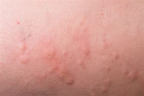 Omalizumab Is Potential Treatment For Chronic Idiopathic Urticaria