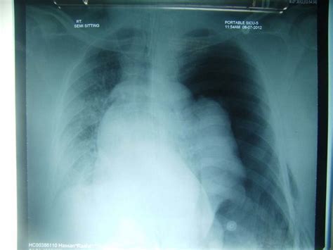 Chest X Ray Showing Tension Pneumothorax Download Scientific Diagram