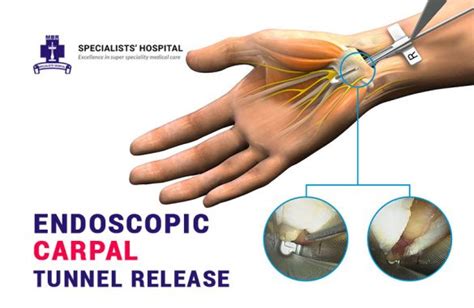 Endoscopic Carpal Tunnel Release Minimally Invasive Relief