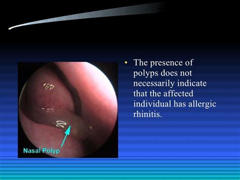 Allergic Rhinitis