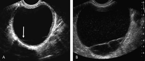 Benign Serous Cystadenomas Both Excised In Early Second Trimester A