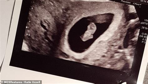 Pregnant Woman 23 Discovers She Has Two Vaginas Wombs And Cervixes Uwinhealth