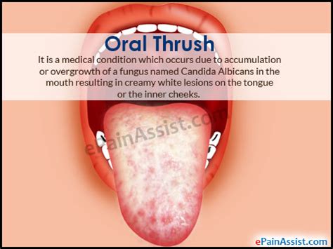 Oral Thrush Medication For Adults Cheaper Than Retail Price Buy