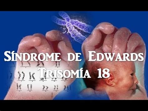 Síndrome de Edwards trissomia 18 causas sintomas e tipos