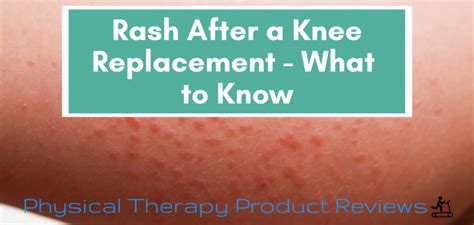 Rash After A Total Knee Replacement What To Know Best Physical