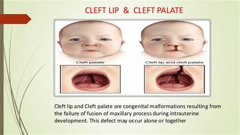 Cleft Lip And Cleft Palate Causes Treatment And Speec