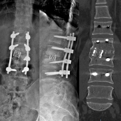 A 39 Years Old Male Presented With L2 3 Tb Reconstructed By Titanium