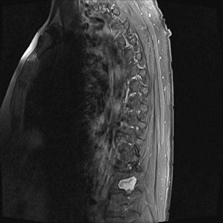 Schwannoma Radiology Reference Article Radiopaedia Org