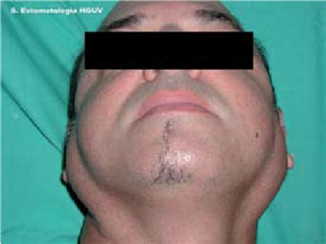 Bilateral Parotid Gland Swelling In A Patient With Sjö Grens Syndrome
