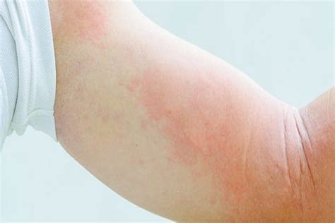 Blanching Skin Causes Symptoms Diagnosis And Treatment