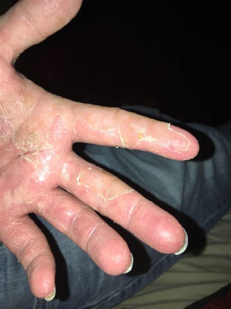 Dyshidrotic Eczema Shellfish Allergy Hands So Swollen Cant Close