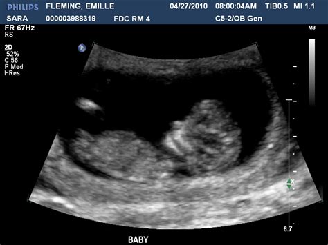 Baby Fleming Week 11 Ultrasound