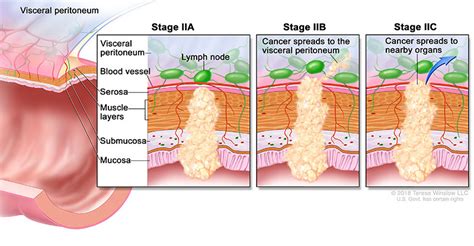 Colon And Rectal Cancer Staging Affiliated Oncologists