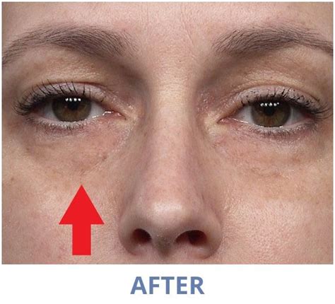 Official Plexaderm Skincare Reduce Under Eye Bags Dark Circles And Wrinkles From View In M