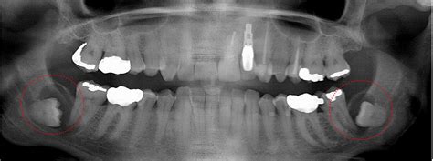 Wisdom Teeth Pathology Triagenics Inc