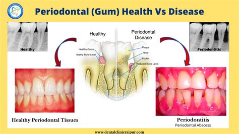 Periodontitis Gingivitis Meaning Symptoms Tx Gum Disease