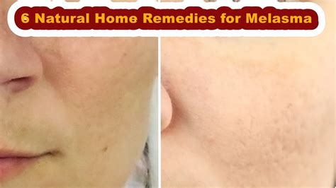 6 Natural Home Remedies For Melasma Youtube