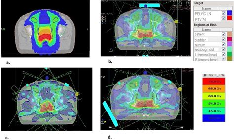 A Axial View Of Dose Distributions For Helical Tomotherapy B Axial