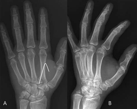 Isolated Volar Fracture Dislocation Of The Base Of The Second