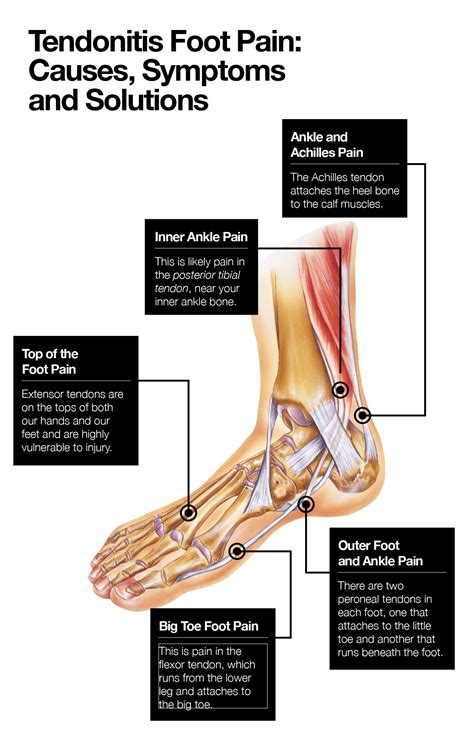 Tendonitis Foot Pain Causes Symptoms And Solutions The Amino Company