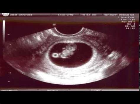 When you're eight weeks pregnant, your baby measures about the size of a kidney bean (rajma). 8 Weeks Pregnant Pictures Compilation| Picture Of 8 Weeks ...