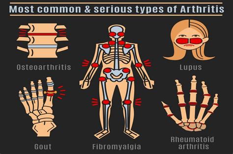 Common Types Of Arthritis That Affect The Knee Betahealthy