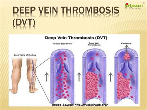 Ppt Deep Vein Thrombosis Dvt Powerpoint Presentation Free To My Xxx