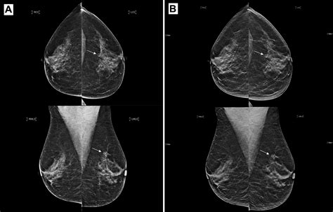 Evidence On Synthesized Two Dimensional Mammography Versus Digital