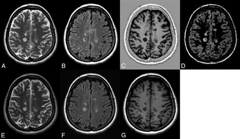 Fig 2 Synthetic MRI In The Detection Of Multiple Sclerosis Plaques