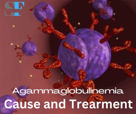 Agammaglobulinemia Cause And Treatment