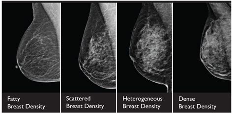 What Does It Really Mean To Have Dense Breasts Wake Radiology