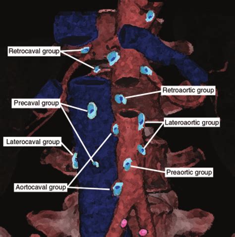 Schematic Shows The Seven Subgroups Of Paraaortic Lymph Nodes The