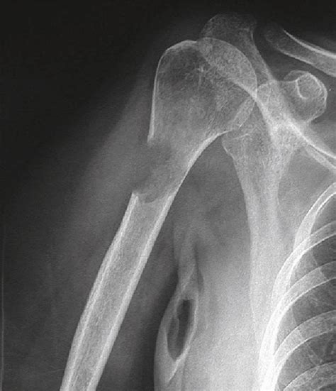 Pathologic Fractures A Breakdown Of Bones Caused By Disease Steve Gallik