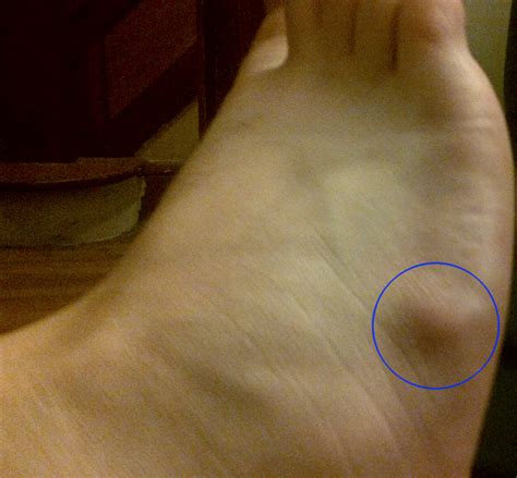 Ganglion Cyst On Top Of The Foot What Is It Feet Firs Vrogue Co